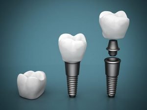 Dental Implants | Dentist Preston