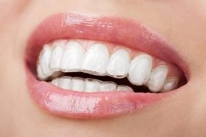 Invisalign | Dentist Preston