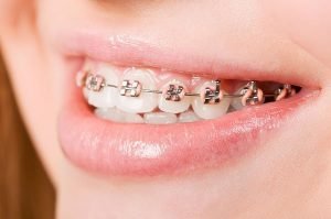 Orthodontics | Dentist Preston