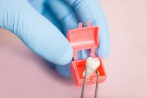 Wisdom Tooth Extraction | Dentist Preston
