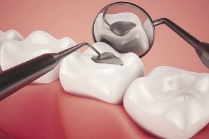 Lost Fillings, Crown Or Inlay/Onlay | Dentist Preston