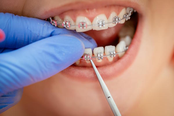 Invisalign vs Traditional Braces - Important Differences