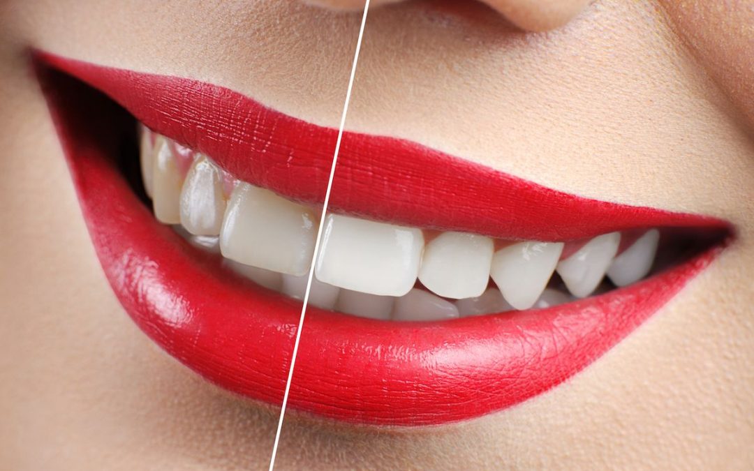 Preston Dentist tips on Teeth Whitening