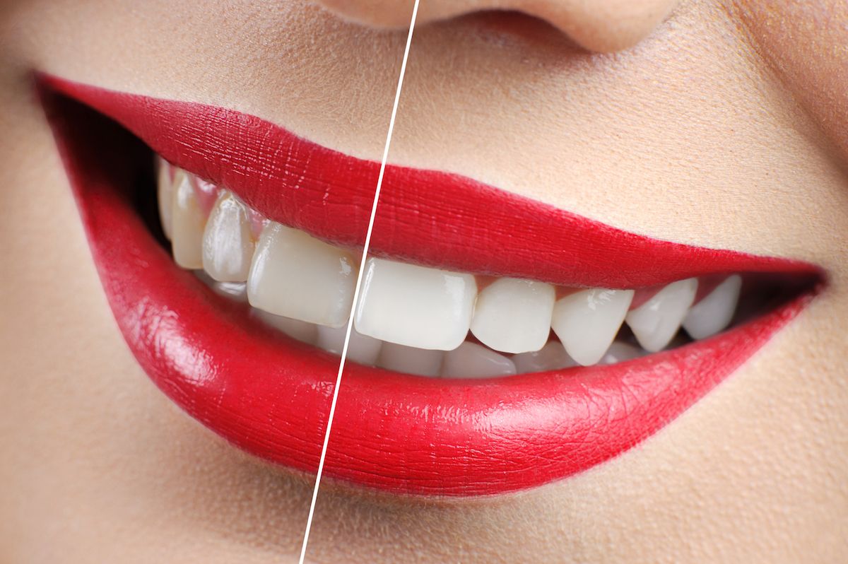Preston Dentist tips on Teeth Whitening
