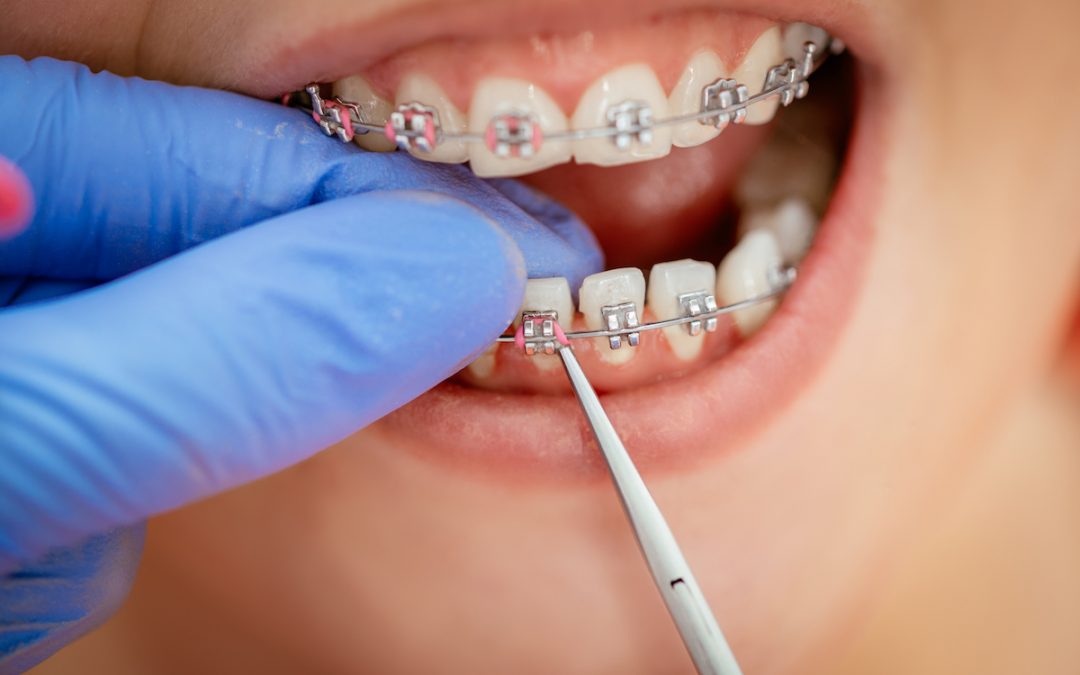 The Fastest Way to Straighten Your Teeth with Orthodontics in Preston